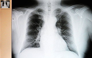 Sukces pulmonologii w Elblągu